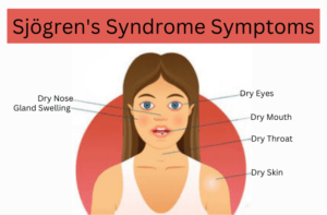 Read more about the article Sjogren’s Syndrome Natural Treatment: Managing Symptoms for a Better Quality of Life